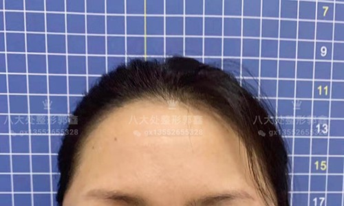 八大处整形郭鑫教授：北京面部吸脂瘦脸案例分享！